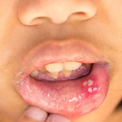 Image of lip blisters